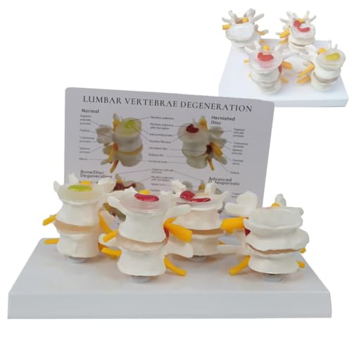 4 Stage Lumbar Vertebrae Model for Anatomy Teaching & Patient Education, Human Spine Anatomy Disease Model with English Back Card, Bone Degeneration & Advanced Osteoporosis Demonstration