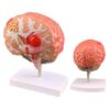 Human Brain Anatomical Model - Malformed Brain Pathological Structure Model, Cerebral Hemorrhage, Cerebral Arteriovenous Malformation, Stroke Pathological Display