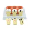 MOWFXUA Anatomical Tooth Model, Removable Anatomical Model of Caries Decomposition, Visual Tool for The Pathological Evolution of Caries