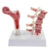 Osteoporosis Spine Model - Human Osteoporosis Anatomical Model, Pathological Changes Visualization, with Study Card - Study Display Teaching Model