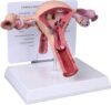 Pathological Uterus Ovary Model Human Female Reproductive Anatomy