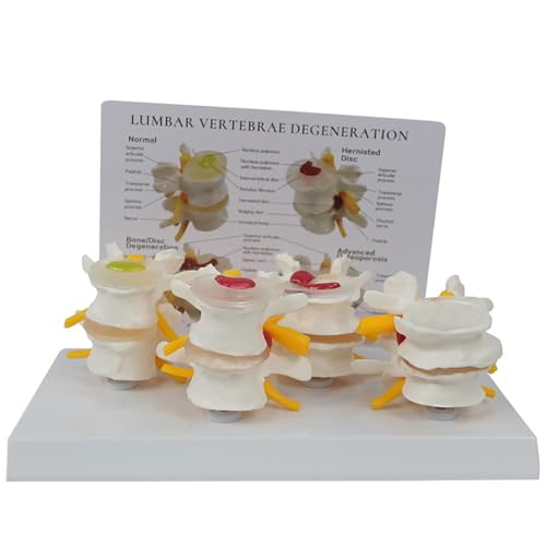 KCOAG 4-Stage Lumbar Vertebrae Model, Human Spine Model, Bone & Disc Degeneration & Advanced Osteoporosis, with English Back Card, Display Herniated Disc, for Learning and Education