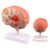 Human Brain Anatomical Model – Malformed Brain Pathological Structure Model, Cerebral Hemorrhage, Cerebral Arteriovenous Malformation, Stroke Pathological Display